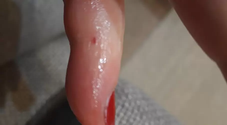 Természetes gyógymód darázscsípésre