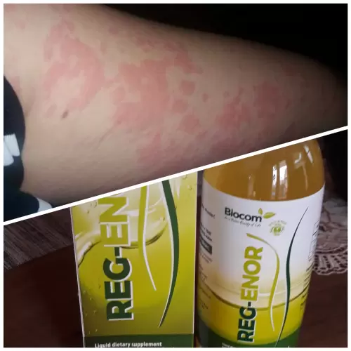 Allergia....egy életre megszabadultunk tőle