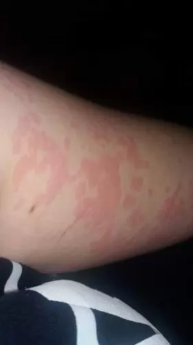 Allergia....egy életre megszabadultunk tőle