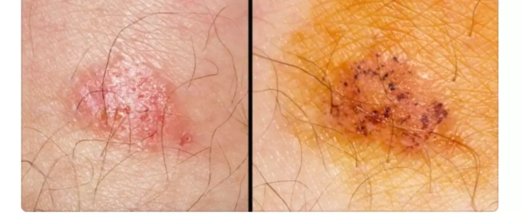 Cum știi dacă suferi de Candida